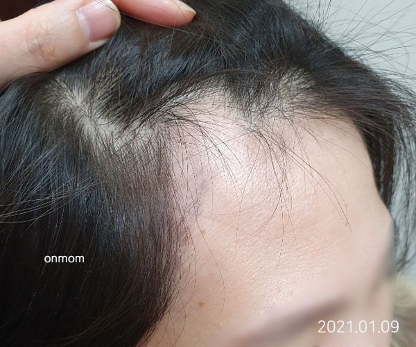 원형탈모, 앞머리탈모 (치료 6개월, 한약 6개월 + 주 1회 탈모관리)