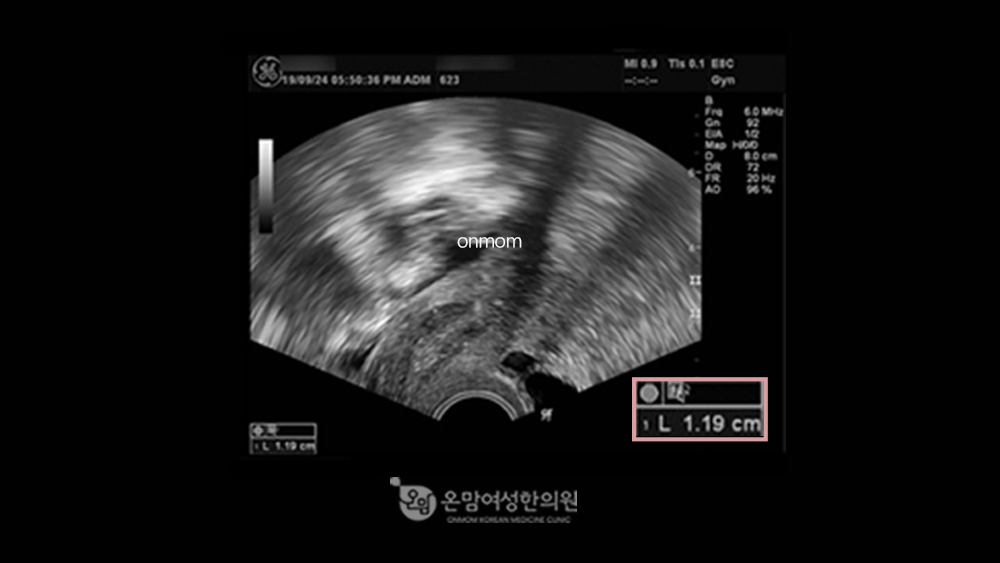 자궁내막증식증-한약,침구치료,좌훈치료 3개월(월경직후 1.19cm-> 증식기 0.74cm)