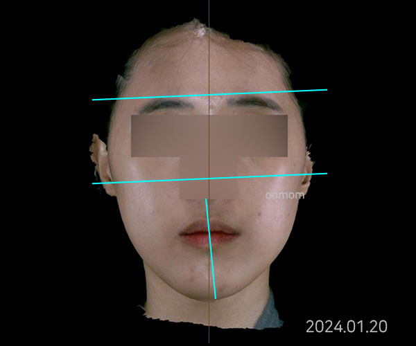 안면비대칭 · 턱소리 + 체형불균형 (치료 40회)